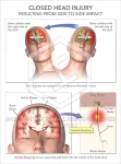 Traumatic Brain Injury